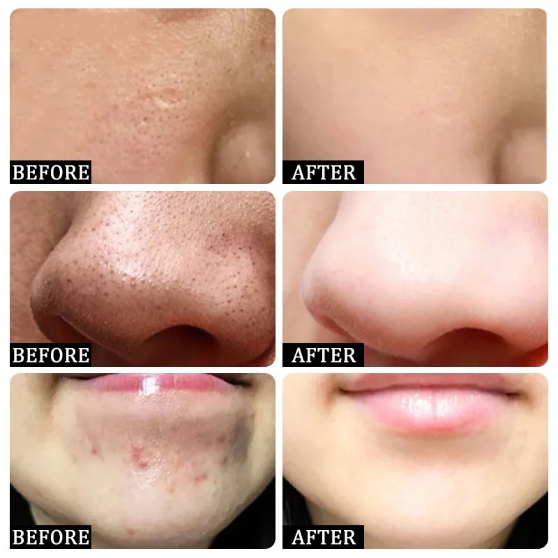 サリチル酸毛穴クリアリングクリーム毛穴を縮小黒ずみ除去にきび - Collagen Peptide Powder のレビューと価格