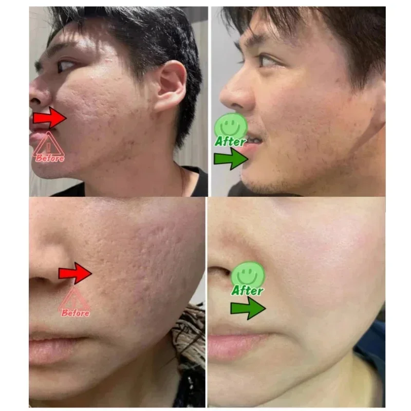 サリチル酸毛穴クリアリングクリーム毛穴を縮小黒ずみ除去にきび - Collagen Peptide Powder のレビューと価格